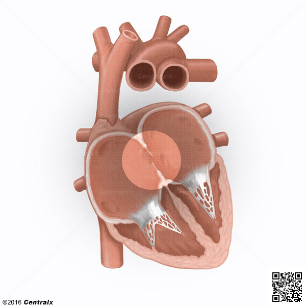Foramen Ovale