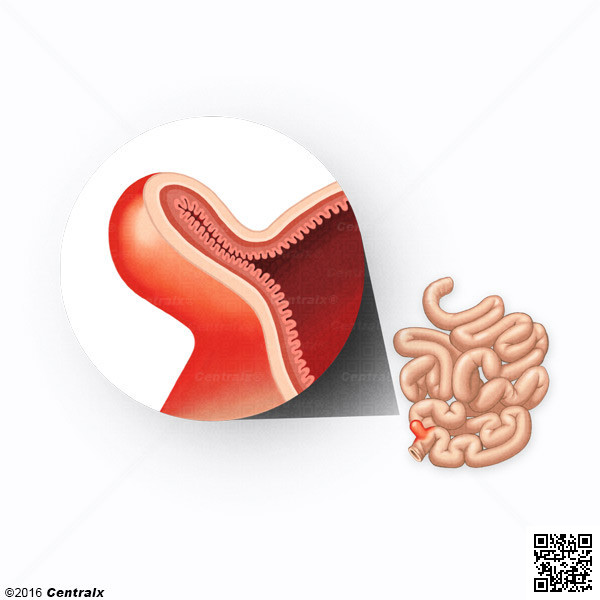 Meckel Diverticulum