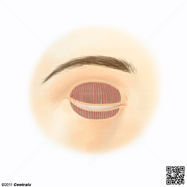Meibomian Glands