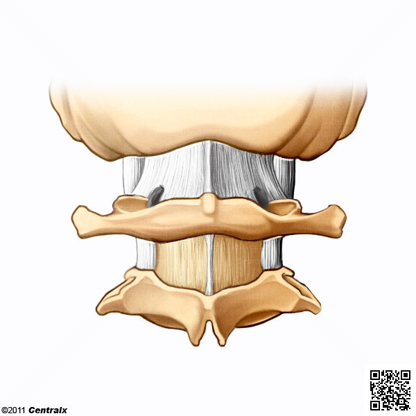Tratament articular atlantoaxial, Articulare hernie occipitale